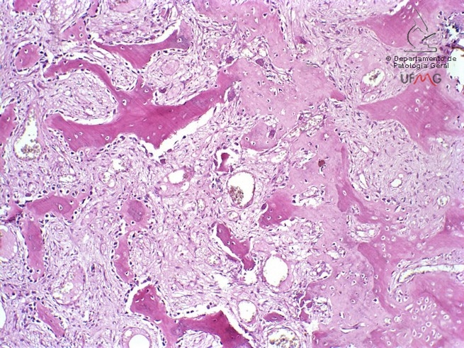 Neoplasia IV 10x